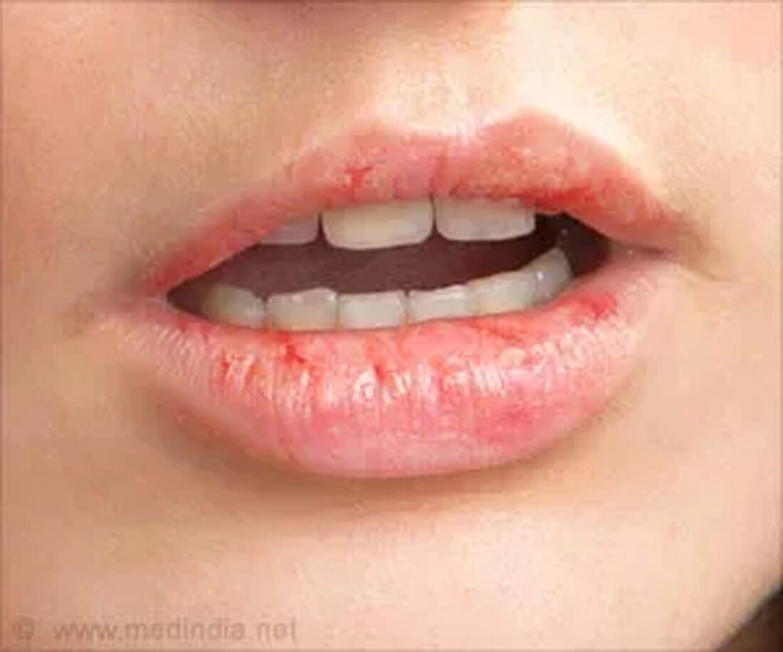 Was sind rissige Lippen? Rissige oder trockene Lippen, die durch Trockenheit, Rötung, Rissbildung, Abblättern und zarte oder wunde Lippen gekennzeichnet sind, sind im Winter häufig. Da Lippen eine dünne Hautschicht haben, neigen sie eher dazu, rissig zu werden. Im Allgemeinen verursachen Sonneneinstrahlung, Austrocknung oder Lippenlecken trockene Lippen. Durch topisches Auftragen von Lippenbalsam oder vermehrte Flüssigkeitsaufnahme werden die Lippen schnell wieder geschmeidig. Rissige Lippen aufgrund von Klimaveränderungen weisen nicht auf eine schwerwiegende gesundheitliche Komplikation hin. Länger anhaltende trockene Lippen können jedoch auf ein ernsthaftes Gesundheitsproblem hinweisen. Manche Menschen entwickeln eine schwerere Form von rissigen Lippen, die als Lippenherpes bezeichnet wird Cheilitis. …