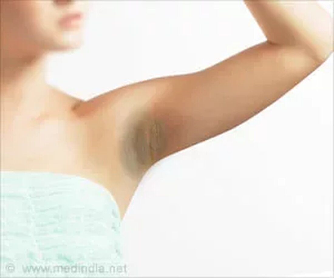 Wie man dunkle Achselhöhlen / dunkle Achselhöhlen loswird Dunkle Achselhöhlen/dunkle Achselhöhlen beziehen sich auf den dunklen Teil der Haut unter dem Arm, der im Vergleich zum Rest des Körpers tendenziell dunkler ist. Es tritt sowohl bei Männern als auch bei Frauen auf, aber normalerweise neigen Frauen dazu, sich mehr Sorgen über dunkle Achselhöhlen zu machen, da dies ihre Chancen verdirbt, während der Sommersaison ärmellose Oberteile oder Kleider zu tragen. Es gibt eine Reihe von Hausmitteln, die helfen können, peinliche dunkle Achselhöhlen loszuwerden. Was sind die häufigsten Ursachen für dunkle Achselhöhlen / dunkle Achselhöhlen? Dunkle Achseln/dunkle Achselhöhlen zu haben, ist keine …
