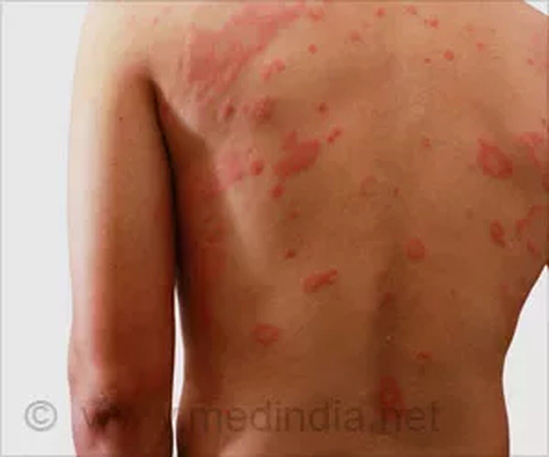 Einführung in die Dermatitis Dermatitis oder Ekzem bedeutet Hautentzündung. Es ist kein Gesundheitszustand; vielmehr handelt es sich eher um ein Reaktionsmuster, das die Haut im Verlauf verschiedener Erkrankungen produziert. Das Wort Dermatitis kommt vom griechischen „derma“ für Haut und „itis“ für Entzündung. Es ist durch verschiedene Symptome gekennzeichnet, wie: Rote und erhabene Blasen Starker Juckreiz Hautausschläge Hautverdickung Die Haut enthält Flüssigkeit, die austritt, wenn Blasen aufplatzen Trockene, schuppige Haut Haut, die brennt und Wunden haben könnte Schwellung Ulzeration Die Arten von Dermatitis werden nach Ort, Ursache oder Aussehen kategorisiert. Die Ursache der Dermatitis ist unbestimmt. Dies hängt jedoch von verschiedenen …