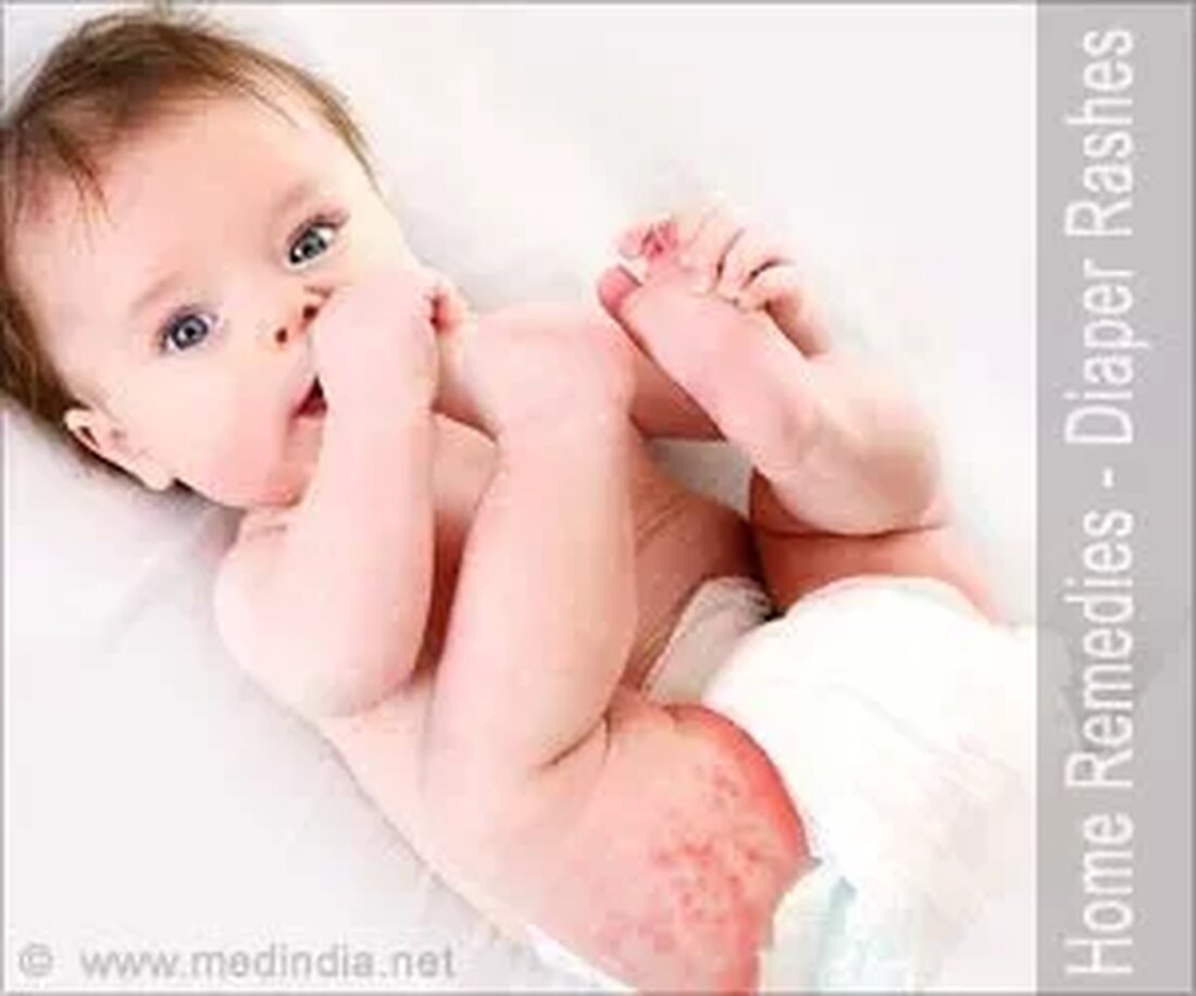 Was sind Windelausschläge? Windelausschlag ist sehr häufig bei Säuglingen und Kindern unter 2 Jahren. Es ist ein Bereich entzündeter Haut, der auf dem Po Ihres Babys erscheint. Die Hautausschläge treten normalerweise aufgrund von selten gewechselten Windeln, Durchfall und der Verwendung von Plastikhosen zum Abdecken von Windeln auf, die Hautreizungen verursachen und manchmal zu bakteriellen oder Pilzinfektionen führen können. Windelausschlag kann auch ältere Menschen betreffen, die aufgrund von Inkontinenz oder Lähmungen Windeln tragen müssen. Die meisten Fälle von Windelausschlag können mit einfachen Behandlungen zu Hause behoben werden, aber falls der Ausschlag anhält oder zunimmt, müssen Sie einen Arzt aufsuchen. Ursachen von …