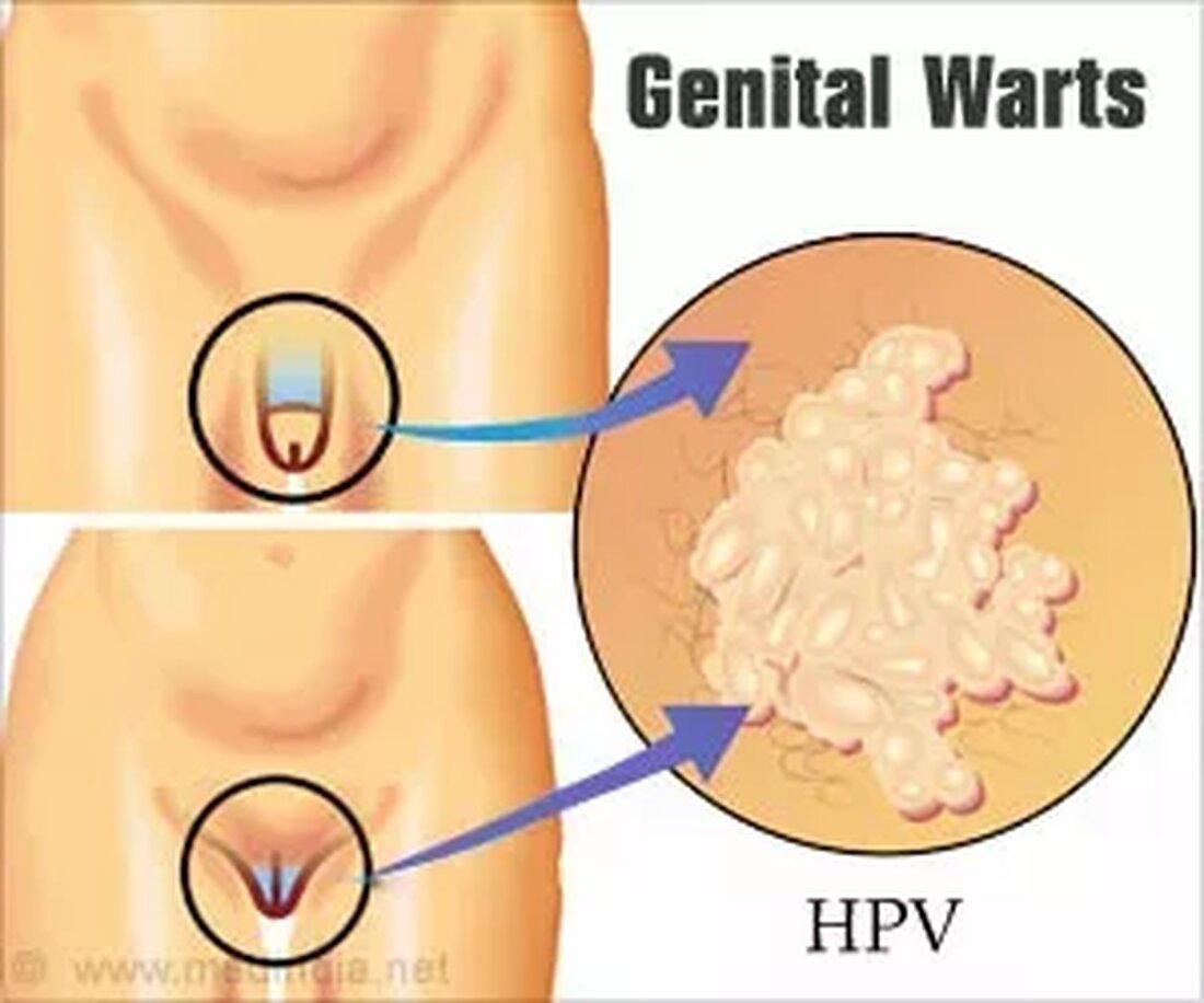 Was sind Genitalwarzen? Genitalwarzen oder Geschlechtswarzen, die kleinen grauen oder fleischfarbenen Beulen, die auf der Haut im Genitalbereich zu finden sind, sind Symptome einer Infektion mit dem humanen Papillomavirus (HPV). HPV wird beim genitalen, oralen oder analen Sex mit einem infizierten Partner von einer Person auf die andere übertragen. Es wird auch durch direkten Haut-zu-Haut-Kontakt beim Sex übertragen. Genitalwarzen werden am häufigsten in Clustern gefunden, was ihnen ein blumenkohlähnliches Aussehen verleiht. Sie befinden sich normalerweise an den äußeren Oberflächen des Körpers wie der Eichel, dem Penisschaft, dem Hodensack, den Schamlippen und um den Anus herum. Warzen können sich auf innere …