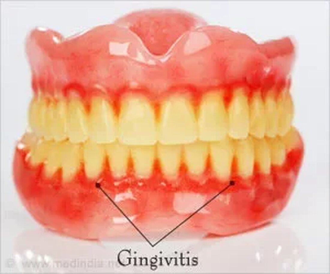 Was ist Gingivitis? Zahnfleischerkrankungen werden ganz einfach durch die Ansammlung von Zahnbelag auf den Zähnen verursacht. Diese Substanz, die sich ständig ansammelt und die Zähne überzieht, enthält Bakterien, von denen die meisten harmlos sind, aber es gibt auch einige, die das Zahnfleisch gefährden. Wenn keine angemessene Zahnhygiene aufrechterhalten wird, bauen sich diese Plaqueablagerungen weiter auf, was zu Zahnfleischreizungen, Entzündungen und Zahnfleischerkrankungen wie Gingivitis führt. Gingivitis ist eine milde Form der Parodontitis, was der klinische Fachausdruck für Zahnfleischerkrankungen ist. Es kann aufgrund von Rötungen, Entzündungen und Schwellungen des Zahnfleisches, das empfindlich wird und wahrscheinlich viel leichter blutet, erhebliche Beschwerden verursachen. Ursachen …