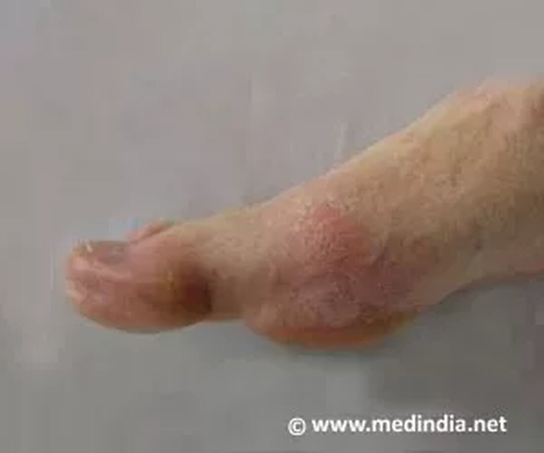 Was ist Gicht? Gicht ist eine akute und äußerst schmerzhafte rheumatische Erkrankung, die durch die Ansammlung von Harnsäurekristallen (Mononatriumurat) in den Gelenken, Sehnen und anderen Geweben des Körpers verursacht wird. Diese Ablagerungen verursachen Arthroseanfälle mit Entzündungen und Schmerzen. Der Anfall kann sich plötzlich während der Nacht entwickeln. Gicht kann häufig am Großzehengelenk und auch an anderen Gelenken wie Fuß, Hand, Knie oder Schulter auftreten. Häufige Ursachen von Gicht Nierenversagen Erbliche Faktoren Fettleibigkeit Diuretika Hoher Blutdruck Alkoholismus Körperliche Belastung Ermüdung Hausmittel gegen Gicht Tipp 1: Kirschen sind vollgepackt mit Antioxidantien und können als hervorragendes Hausmittel zur Linderung von Gichtschmerzen verwendet werden. …