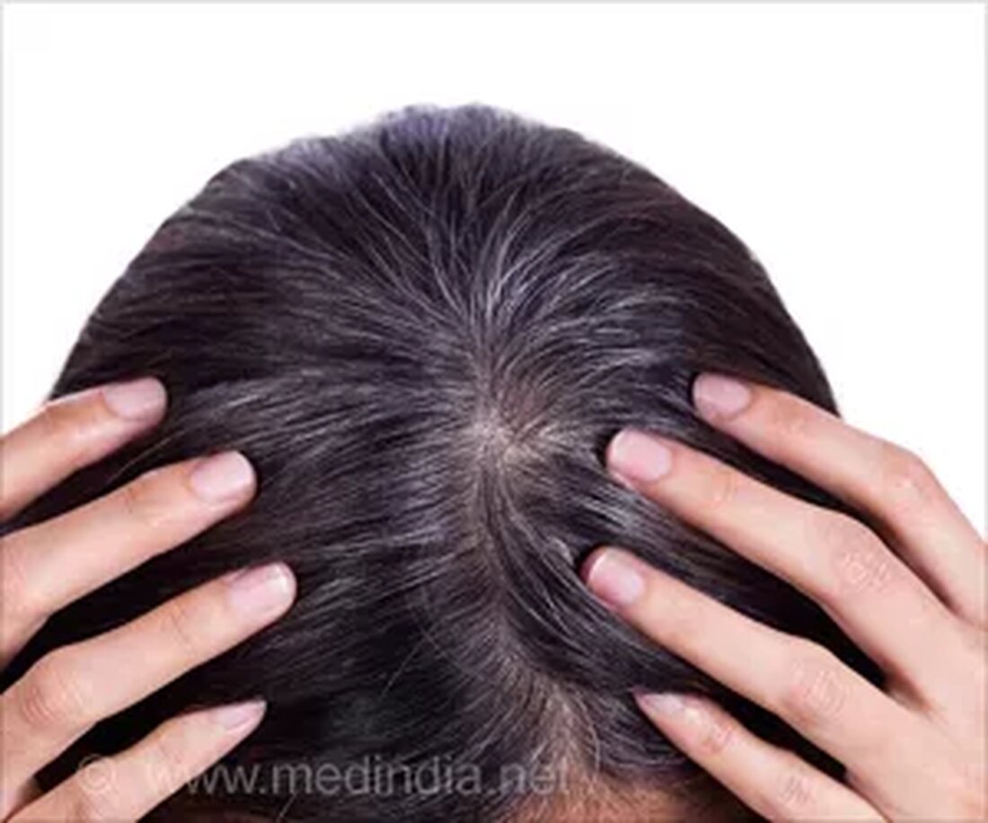 Was ist graues Haar? Graues Haar ist ein sichtbares Zeichen des Alterns und ein natürlicher Bestandteil des Älterwerdens. Es bedeutet eine Mischung aus weißem Haar, gemischt mit schwarzem Haar, wodurch das graue Aussehen des Haares entsteht, das auch als Salz und Pfeffer auf der Kopfhaut bekannt ist. Es ist Haar mit wenig oder keinem Pigment und bei dem Licht reflektiert wird, nachdem es auf das Haar gefallen ist, wodurch es grau erscheint. Viele von uns könnten graue Haare haben. Ab dem ersten Mal, wenn eine Person einen Haufen grauer Haare bemerkt, kann es etwa zehn Jahre dauern, bis alle Haare …