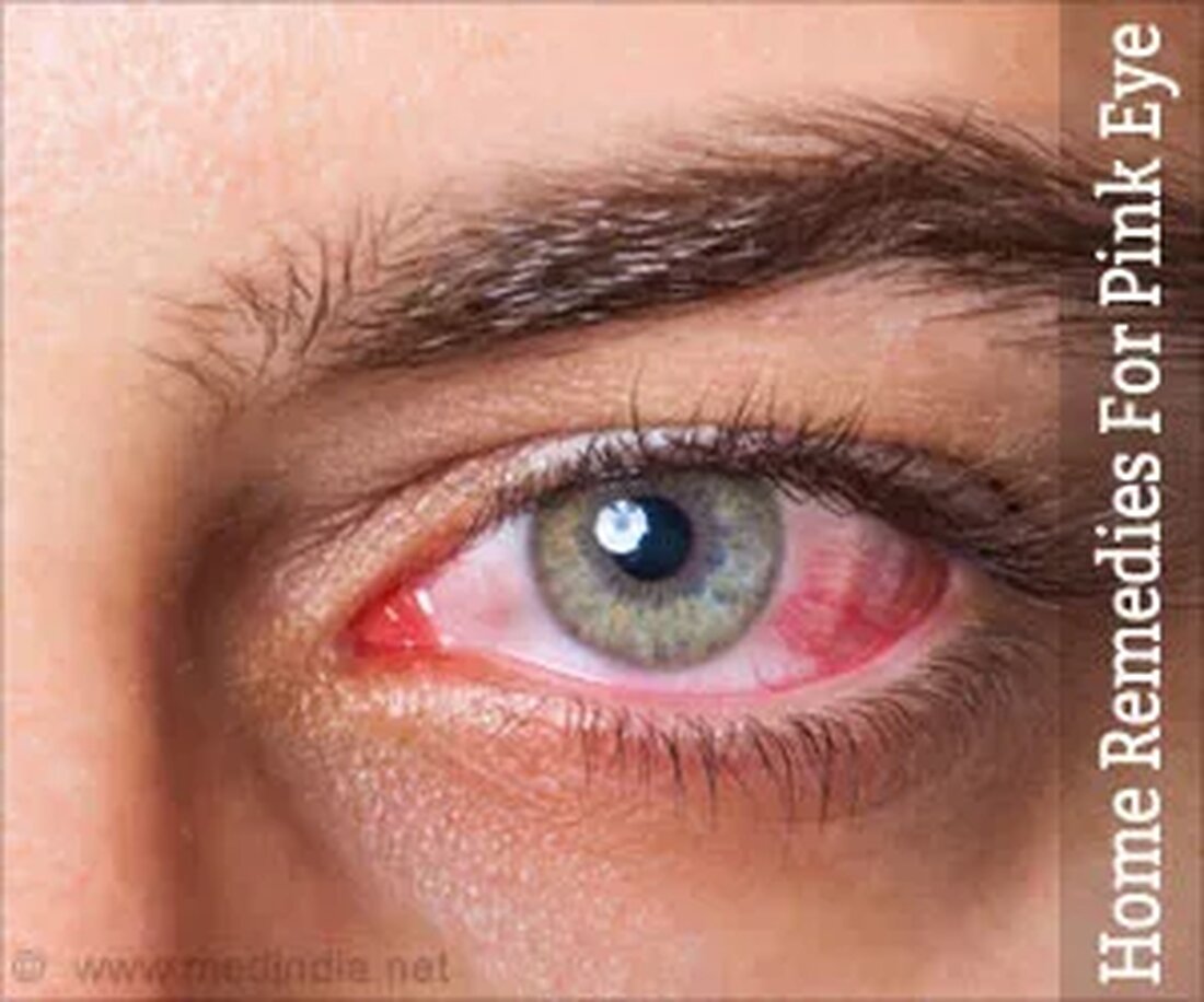 Was ist Pink Eye? Bindehautentzündung ist eine entzündliche Erkrankung, die die Bindehaut betrifft, eine dünne Membran, die das Weiße der Augen umhüllt. Diese dünne Membran hilft, die Augen feucht und geschmiert zu halten, indem sie Schleim und Tränen produziert, und sie schützt auch vor Mikroben, die sonst in das Auge gelangen würden. Die Bindehaut kann manchmal aufgrund von bakteriellen oder viralen Infektionen oder auch als Folge einer allergischen Reaktion entzündet und gereizt werden. Dieser Zustand der entzündeten Bindehaut wird aber Konjunktivitis genannt wird wegen des charakteristischsten Merkmals der Erkrankung allgemein als Bindehautentzündung bezeichnet – einer Rötung der Augen. Es sind &hellip;
