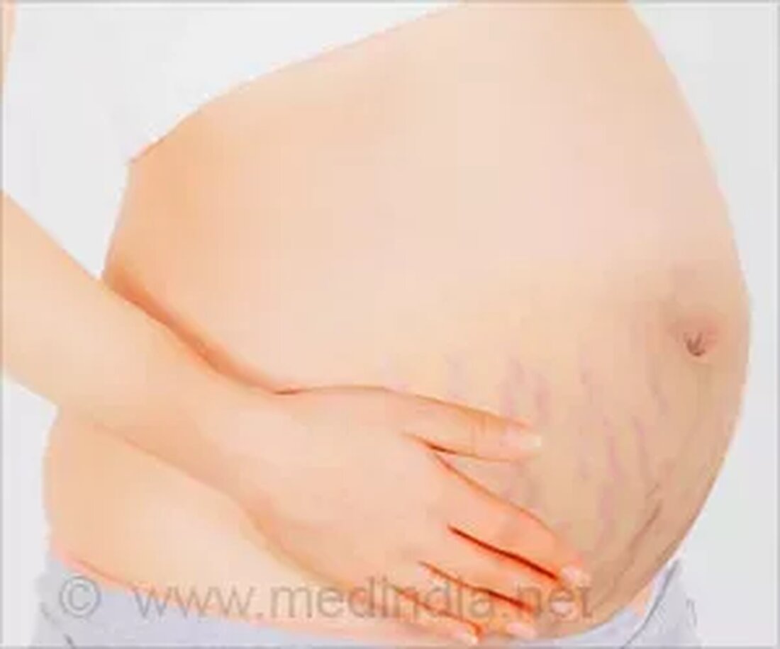 Was sind Dehnungsstreifen? Dehnungsstreifen sind auch als Striae gravidarum, Striae distensae und Striae atrophicans bekannt. In einer im British Journal of Dermatology veröffentlichten Studie fanden Frank Wang und seine Kollegen heraus, dass das elastische Fasernetzwerk in der Dermis bei einer Dehnungsstreifen gestört wird. Die Haut besteht aus drei Hauptschichten – der Epidermis (der äußeren Schicht), der Dermis (der mittleren Schicht) und der Hypodermis oder Subkutis (der tiefsten Schicht). Die Dehnung des Bindegewebes in der Haut über die Grenzen seiner Elastizität hinaus führt während der Schwangerschaft zu einem Riss in der Lederhaut, wodurch die Blutgefäße und die tieferen Hautschichten durchscheinen. Dies …