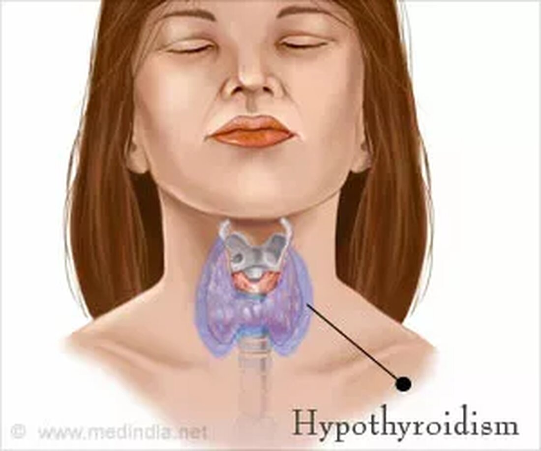 Was ist Hypothyreose? Hypothyreose, auch bekannt als Schilddrüsenunterfunktion, ist eine häufige endokrine Störung, die zu einer unzureichenden Produktion von Schilddrüsenhormonen führt. Die Schilddrüse ist eine schmetterlingsförmige endokrine Drüse im vorderen Teil des Halses, die eine wichtige Rolle im Stoffwechsel und Wachstum spielt. Hypothyreose kann in jedem Alter auftreten, aber Menschen über 45 Jahre sind anfälliger, ältere Frauen ab 60 Jahren haben ein erhöhtes Risiko für Hypothyreose. Hypothyreose führt zu Müdigkeit, schwacher Immunität, aufgeblasenem Gesicht, Schwellungen am Körper, trockener Haut, unregelmäßigem Menstruationszyklus, Muskelkrämpfen und plötzlicher Gewichtszunahme. Was sind die Ursachen einer Hypothyreose? Hypothyreose kann verschiedene Ursachen haben, darunter Schilddrüsenoperationen, Autoimmunerkrankungen, Medikamente, &hellip;