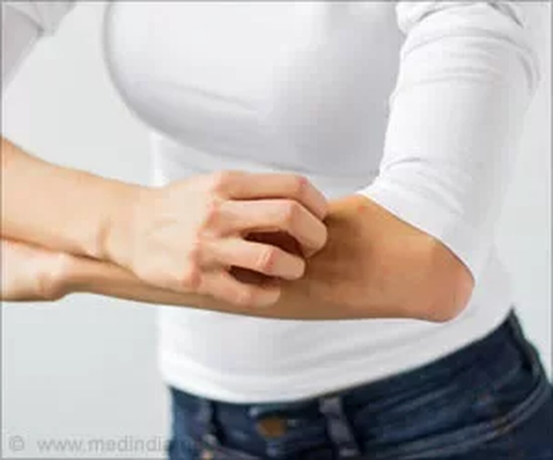 Was ist juckende Haut? Juckende Haut, auch bekannt als Pruritus, ist eine unangenehme Hautirritation, die Sie dazu bringt, den betroffenen Bereich zu kratzen, um das juckende Gefühl zu lindern. Juckreiz ist ein häufiges Problem bei jedem und kann zu einem Hautausschlag oder einer anderen Erkrankung führen. Die Hauptursachen für Juckreiz können von trockener Haut, Insektenstichen, Hautläsionen, inneren Erkrankungen wie Leber- oder Nierenerkrankungen bis hin zu Hautausschlägen und Allergien reichen. Häufige Ursachen für juckende Haut Die folgenden sind die häufigsten Ursachen für juckende Haut: Hautläsionen Trockene Haut Innere Krankheiten Blase Ekzem Schwangerschaft Menopause Allergene Insektenstiche oder -stiche Mangelnde Hygiene Drogen Hausmittel …