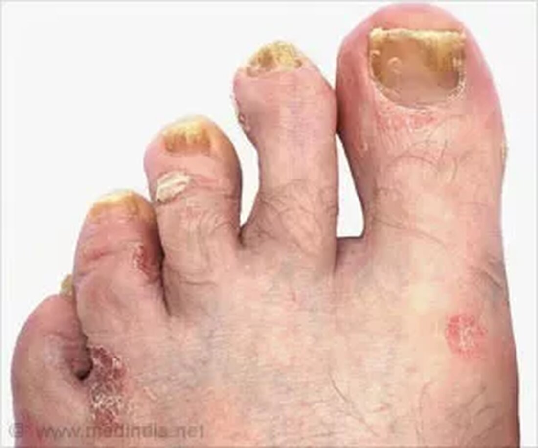 Was ist Nagelpilz? Eine Nagelpilzinfektion wird durch einen Pilz verursacht, der die Keratinzusammensetzung des Nagels befällt. Eine Nagelpilzinfektion ist nicht auf einen bestimmten Teil des Nagels beschränkt, sondern kann alle Teile des Nagels wie Nagelplatte, Nagelbett und Nagelwurzel betreffen. Die Infektion entwickelt sich allmählich zu verfärbten, verdickten und gesprenkelten Nägeln. Zehennagelpilz tritt häufiger auf als Fingernagelpilz. Feuchte Umgebung, regelmäßige Schäden am Nagel, schlechter Allgemeinzustand, Vorerkrankungen wie Diabetes oder Psoriasis und das Tragen unbequemer Schuhe erhöhen die Anfälligkeit für Zehen- oder Fingernagelpilz. Was verursacht Nagelpilz? Nagelpilz (Zehennagelpilz und Fingernagelpilz) ist eine der häufigsten Erkrankungen, die durch Dermatophyten-Pilzinfektionen verursacht werden. Die häufigsten …