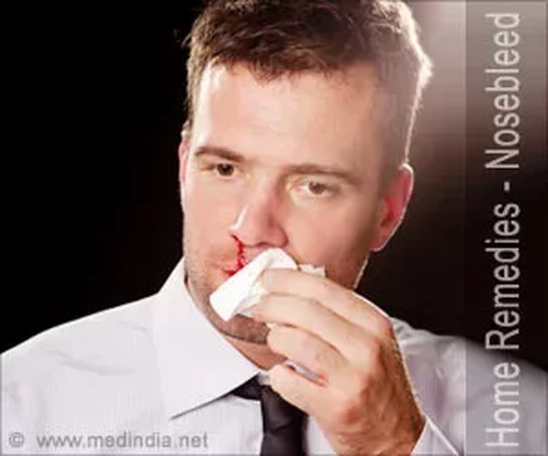 Was ist Nasenbluten? Nasenbluten, auch Epistaxis genannt, ist eine häufige Erscheinung, die mit einfachen Erste-Hilfe-Maßnahmen zu Hause behandelt werden kann. Nasenbluten wird normalerweise durch Nasenbohren oder eine Infektion der Schleimhaut ausgelöst, die Trockenheit verursacht. Auch ein Schlag auf die Nase kann ein Grund für Nasenbluten sein. Das Vorhandensein vieler Blutgefäße in der Nase macht sie anfälliger für Blutungen, selbst wenn sie leicht beschädigt ist. Die meisten Nasenbluten treten im vorderen Teil der Nase auf und hören innerhalb weniger Minuten auf. Die meisten Nasenbluten sind nicht schwerwiegend. Häufige Ursachen von Nasenbluten Nasenbohren Nasenverletzung Erkältung oder Grippe Einfügen von kleinen Objekten Allergien …