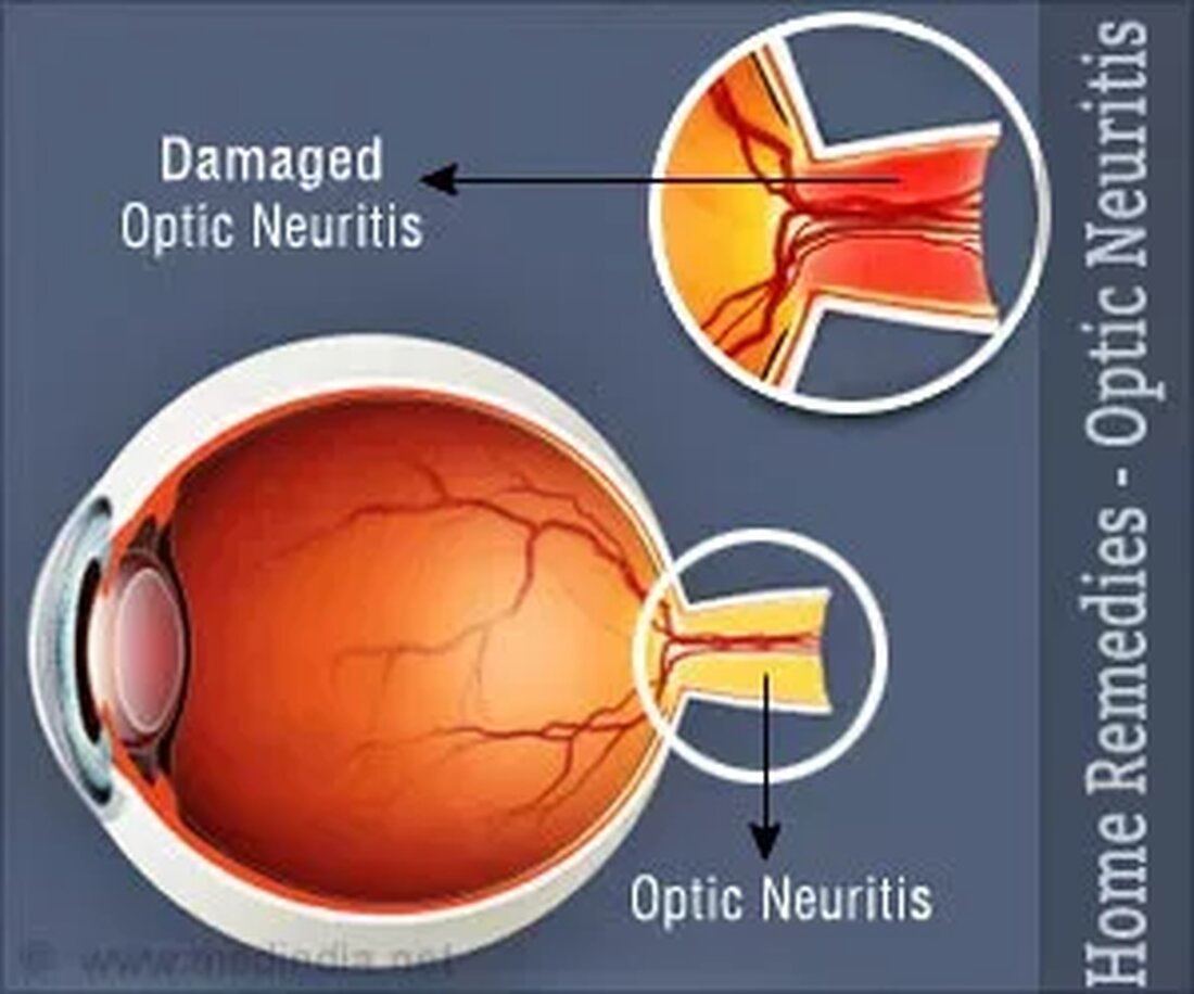 Was ist Optikusneuritis? Optikusneuritis bezieht sich auf die Schwellung des Sehnervs, des Nervenfaserbündels, das Signale vom Auge zum Gehirn überträgt. Sie wird auch als retrobulbäre Neuritis bezeichnet. Die Entwicklung einer Optikusneuritis ist eine ernsthafte Erkrankung, die zu einer Beeinträchtigung des Sehvermögens und in einigen Fällen zum Verlust des Sehvermögens führt. Betroffene leiden unter Schmerzen, einer Beeinträchtigung des Farbsehens sowie einer beeinträchtigten Beurteilung der Sehtiefe. Optikusneuritis kann vorübergehend sein, wenn das Sehvermögen nach der Behandlung wiederhergestellt wird. Steroide werden zur schnelleren Wiederherstellung des Sehvermögens verschrieben. Optikusneuritis ist von 2 Haupttypen: Typisch – Optikusneuritis, die sich als Folge von Multipler Sklerose entwickelt …