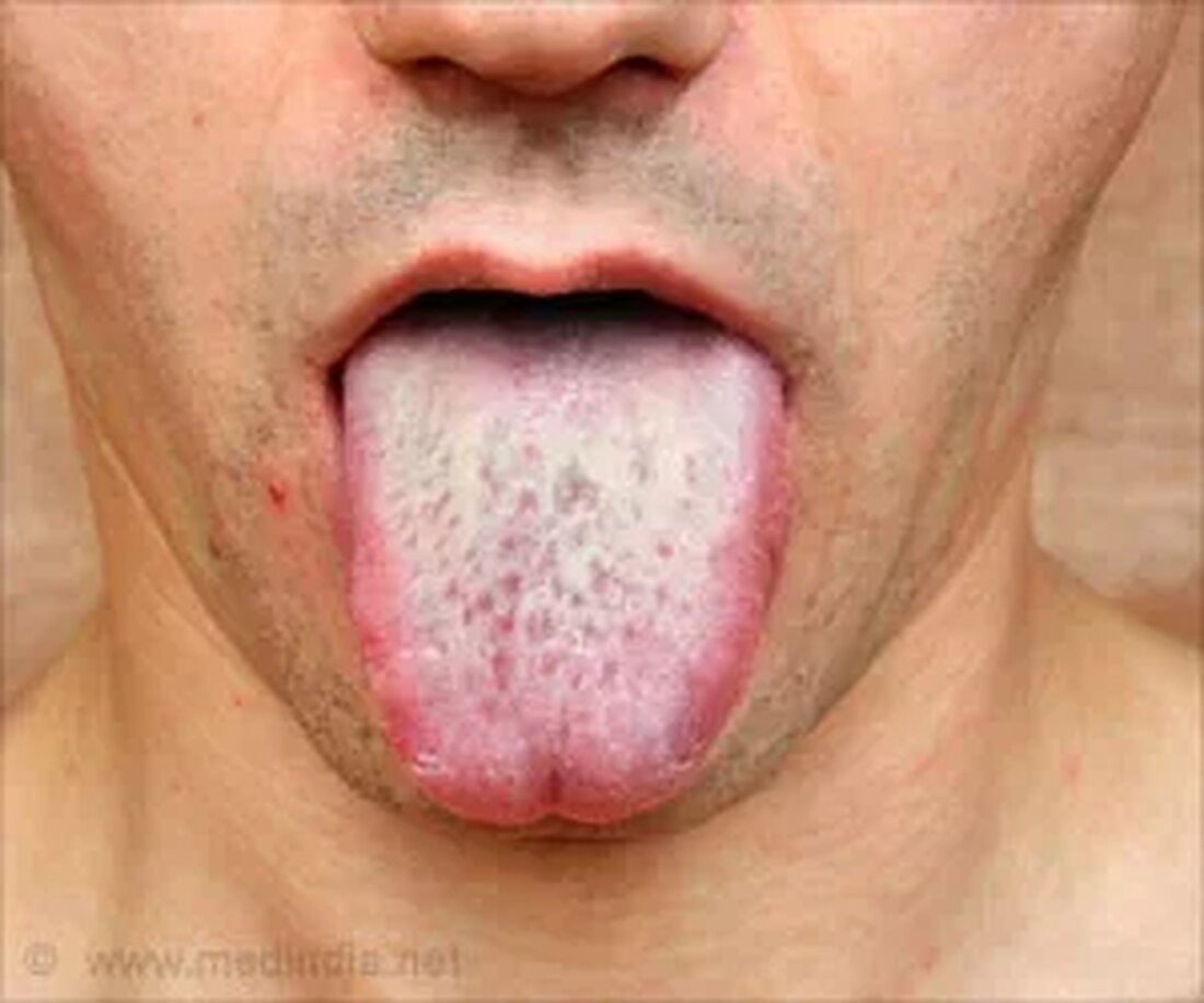 Was ist Mundsoor? Mundsoor ist eine Infektionskrankheit, die die Schleimhaut um die Zunge, das Zahnfleisch und die inneren Wangen befällt. Es wird durch einen Hefepilz namens Candida albicans verursacht, der normalerweise Säuglinge befällt. Erwachsene können auch aufgrund anderer zugrunde liegender Erkrankungen von dieser Infektion betroffen sein. Es heißt auch orale Candidiasis. Was sind die Ursachen für Mundsoor? Mundsoor betrifft vor allem Säuglinge, da sie ein schwächeres Immunsystem haben. Candida albicans ist ein häufiger Pilz, der in der Haut, der Schleimhaut von Mund und Darm vorkommt. Aber manchmal kann es überwuchern und weiße milchige Läsionen auf der Schleimhaut verursachen, die schmerzhaft …