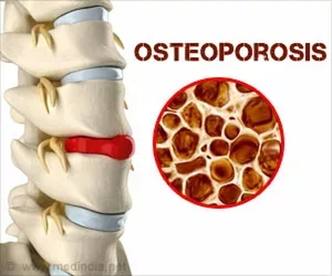Was ist Osteoporose? Osteoporose ist eine Erkrankung der Knochen, bei der die Knochen dünn und spröde werden und leicht brechen. Etwa 200 Millionen Menschen auf der Welt leiden an dieser Krankheit. Osteoporose tritt aufgrund der kombinierten Wirkung von niedriger Knochendichte und Auflösung der inneren Mikroarchitektur des Knochens auf. Frakturen werden am häufigsten in den Knochen des Handgelenks, der Hüfte und der Wirbelsäule beobachtet. Der Zustand betrifft jedoch auch andere Knochen. Osteoporose führt zu einer Veränderung der Knochenmineraldichte und beeinträchtigt die Knochenqualität. Die Knochendichte ist die Mineralkonzentration pro Volumeneinheit oder Fläche des Knochens. Es umfasst eine Kombination aus Knochenmasse und Menge …