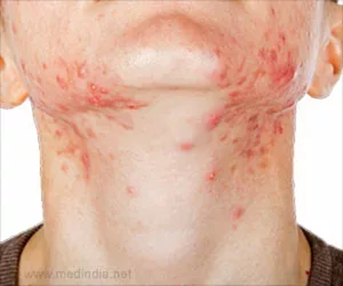 Was ist Stachelige Hitze? Die steigenden Temperaturen bringen eine Reihe von Hautkrankheiten mit sich, die ziemlich lästig sein können. Eine solche, ziemlich häufige Bedingung ist stachelige Hitze, auch als Hitzeausschlag oder Schweißausschlag bezeichnet. Klinisch als Miliaria bekannt, können Schweißausschläge überall am Körper auftreten. Während es am häufigsten als Achselschweißausschlag gesehen wird, kann es sich auch um die Leiste, die Füße, den Rücken, den Nacken, die Hände, die Brust und den Bauch manifestieren. In einigen schweren Fällen von stechender Hitze kann eine Person auch Hautausschläge im Gesicht und am Hals sehen. Dieser Zustand betrifft Erwachsene und Säuglinge gleichermaßen. Häufige Ursachen für …