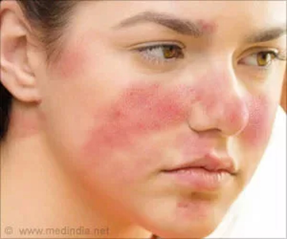 Rosacea ist eine chronische Hauterkrankung, die dazu führt, dass die Haut in winzigen roten Beulen ausbricht. Andere Symptome von Rosacea sind Rötung des Gesichts, Gesichtsrötung, Flecken und manchmal Augenprobleme wie trockene Augen. Nicht alle Symptome treten gleichzeitig oder in allen Fällen auf. Menschen jeden Alters können Rosacea bekommen, aber es ist häufiger bei Erwachsenen über 30 Jahren. Frauen mit heller Haut oder Menschen mit schottischen, irischen und englischen Vorfahren sind anfälliger für Rosacea. Ursachen von Rosacea Die Ursache von Rosacea ist noch nicht bekannt. Es wird angenommen, dass eine Kombination aus Genetik und Umweltfaktoren für das Auftreten von Rosacea verantwortlich …