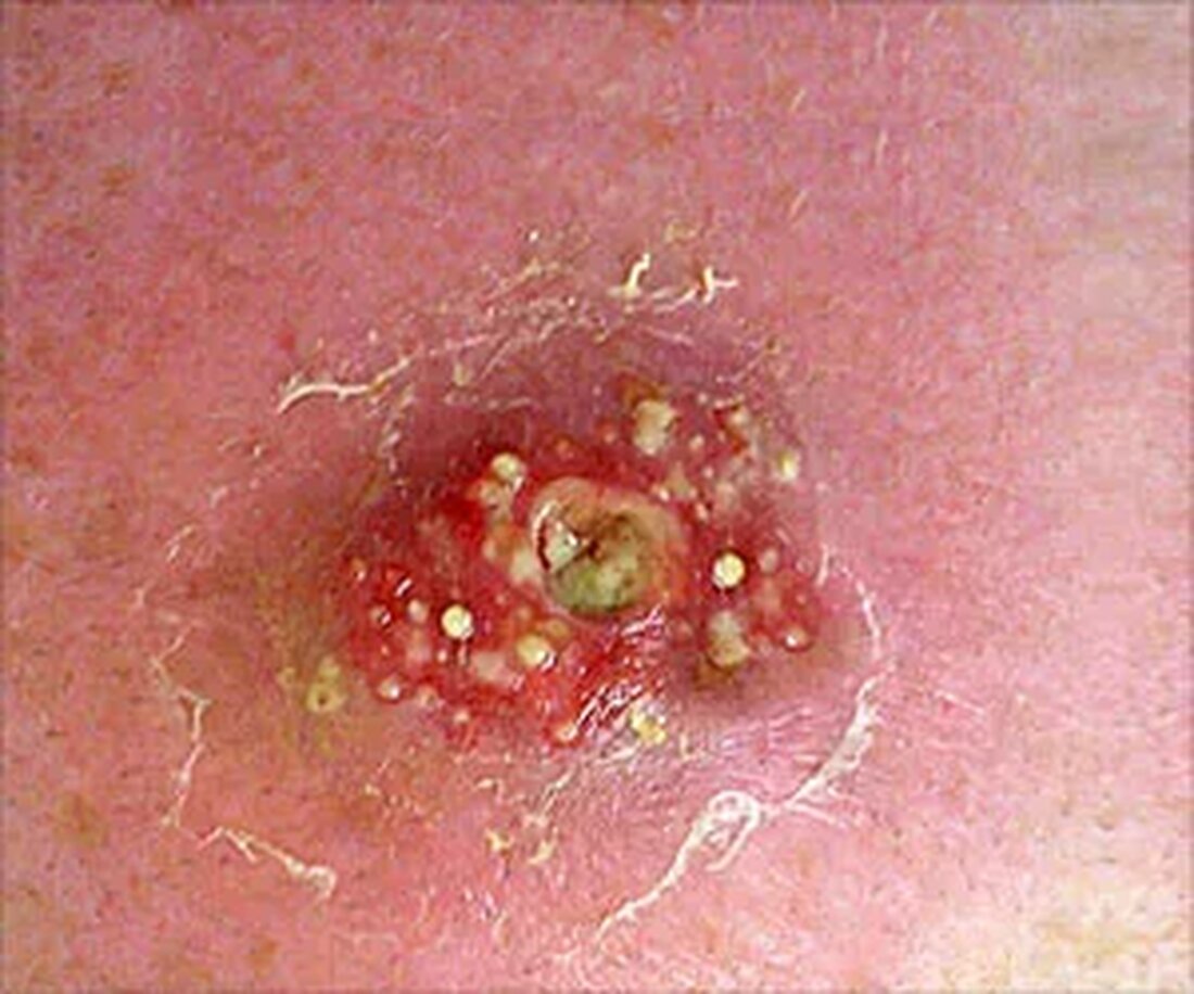 Eine Staphylococcus-aureus-Infektion oder Staphylokokken-Infektion, wie sie allgemein bekannt ist, tritt auf, wenn Staphylokokken-Bakterien durch verletzte Haut in den Körper gelangen und Haut und Blut infizieren. Die Staphylokokken-Bakterien befinden sich normalerweise auf der äußeren Haut, der Nase und den Genitalien und beeinträchtigen die Person normalerweise nicht. Aber ein Schnitt oder eine Wunde auf der Haut kann dazu führen, dass Bakterienstämme in die Haut und den Blutkreislauf gelangen und schwere Infektionen verursachen. Es führt zu Rötungen, Schwellungen, Juckreiz, mit Eiter gefüllten Furunkeln und schmerzhaften Hautausschlägen am Körper, die am meisten Gesicht und Hals betreffen. Eine selbst schwerwiegende Infektion kann Blut, Knochen, Herz …