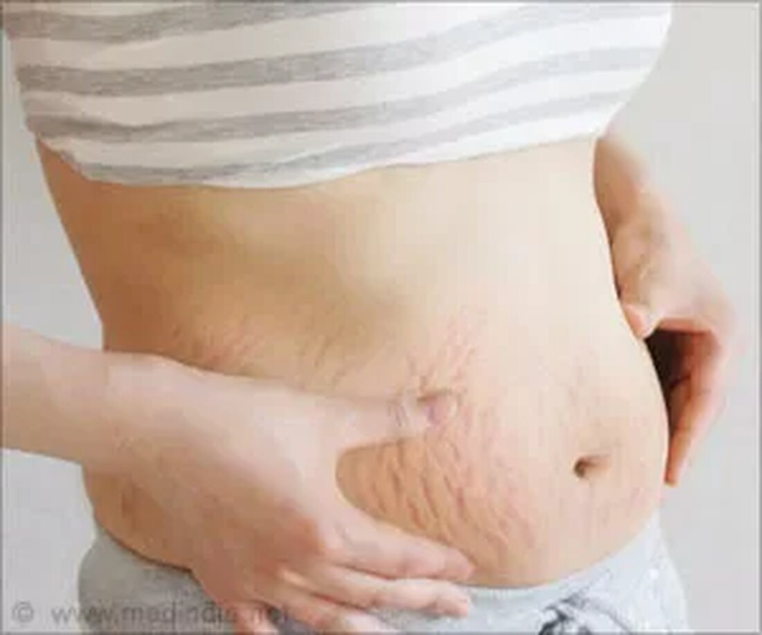 Dehnungsstreifen sind das Ergebnis einer plötzlichen Gewichtszunahme. Sie erscheinen als rote, violette oder rosa lineare Streifen auf Bauch, Gesäß, Brüsten, Oberschenkeln und Oberarmen. Wenn der Körper schneller wächst, als die Haut mithalten kann, reißen die elastischen Fasern unter der Hautoberfläche und dies verursacht Dehnungsstreifen. Striae distensae ist die medizinische Bezeichnung für Dehnungsstreifen. Sie sind extrem häufig, schmerzlos und sind selten ein Zeichen für ein medizinisches Problem. Ursachen von Dehnungsstreifen Das Hauptprotein, aus dem das Bindegewebe der menschlichen Haut besteht, heißt Kollagen. Eine Überdehnung der Haut stört und schädigt die normale Kollagenproduktion. Dieser Prozess führt dann zu Dehnungsstreifen. Dehnungsstreifen können aus …