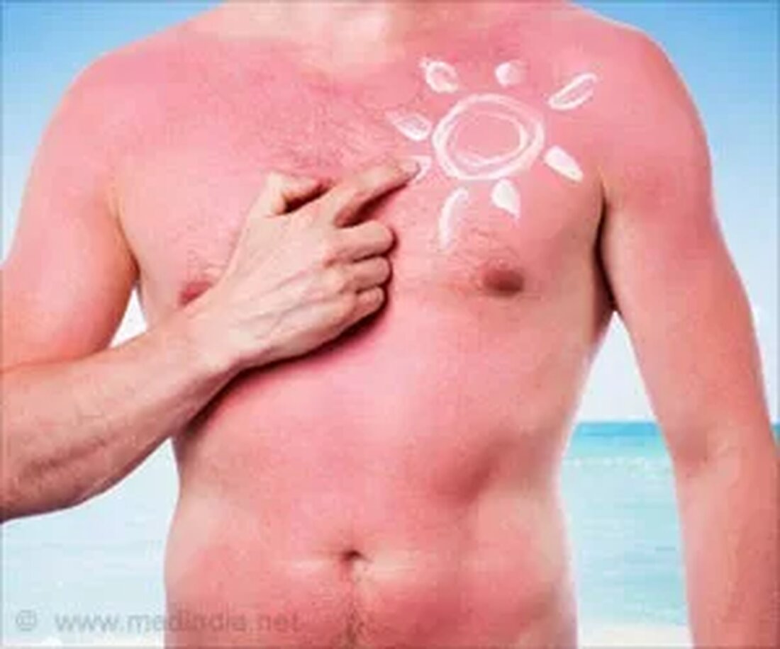 Was ist Sonnenbrand? Sengende Hitze und Sonne können Rötungen, Schmerzen und Juckreiz auf Ihrer Haut verursachen. Es liegt an den schädlichen UV-Strahlen der Sonne, die Sonnenbrände verursachen, wenn die Haut ihnen längere Zeit ausgesetzt ist. Sonnenbrände können insofern schädlich sein, als sie zu Hautproblemen wie dunklen Flecken, Falten und sogar Hautkrebs führen können. Daher ist es erforderlich, diesen schmerzhaften Zustand sofort zu behandeln. Es ist immer gut, extreme Sonneneinstrahlung zu vermeiden, um Sonnenbrände zu reduzieren, aber selbst wenn sie auftreten, müssen Hausmittel die erste sofortige Behandlung sein, um die Symptome zu lindern. Was verursacht Hautverbrennungen Ultraviolette Sonnenstrahlen sind die einzige …