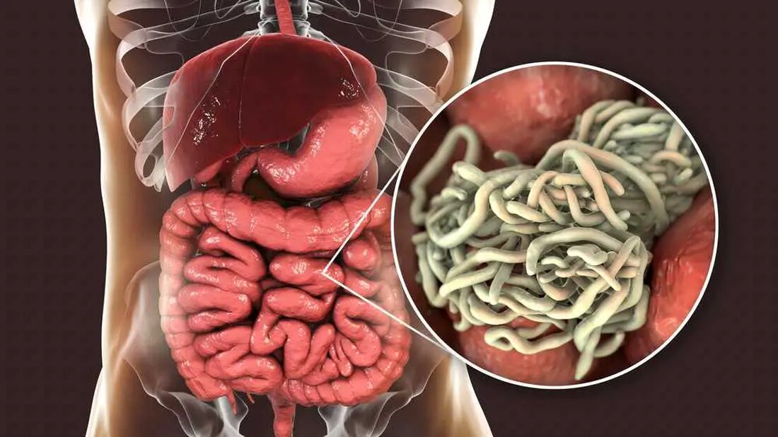 Parasiten sind Organismen, deren Überleben auf einen Wirt angewiesen ist. Sie heften sich an einen anderen lebenden Organismus oder dringen in ihn ein, ernähren sich von den Nährstoffen ihres Wirts und verursachen dabei häufig gesundheitliche Probleme. Der Wirt kann unter einer Reihe gesundheitlicher Probleme leiden, von leichten Magen-Darm-Beschwerden bis hin zu schwächenden Krankheiten. Diese unwillkommenen Gäste können auf verschiedene Weise in Ihren Körper eindringen: durch den Verzehr von kontaminierter Nahrung oder Wasser, durch Insektenstiche, durch sexuellen Kontakt oder auch einfach durch Barfußlaufen auf kontaminiertem Boden. Die gute Nachricht ist jedoch, dass eine sorgfältige Auswahl der Nahrungsaufnahme als natürlicher Abwehrmechanismus gegen …