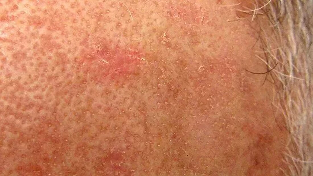 Aquí Encontrará Los Remedios Caseros Más Comunes Para Queratosis Actíica. Incluso si a Veces Es Difficil Enconttrar El Remodio Casero Adecuado, Een Veces Nav Esta Tan Lejos. La Caraorría de los Remedios Caseros Ya Los Tienen en su hogar, Como Su Nombre Indica. Las vitaminas de todo tipo sin buenas para su cuerpo y piel, perou su cuerpo esta exuesto a demasiadas vitamīni, peede ser pelvoso. Como dice el viejo dicho, demasiado Todo es Malo. ESTA ESCTATMENTS LA RAZón Por la que nos vimos obvenznik Escrur Sobre ESO. Las Heeft del Lemlem Problém Moderno Sezocent Todos Los Días. Los Científicos y Los Eksperts en salud dicen que ...