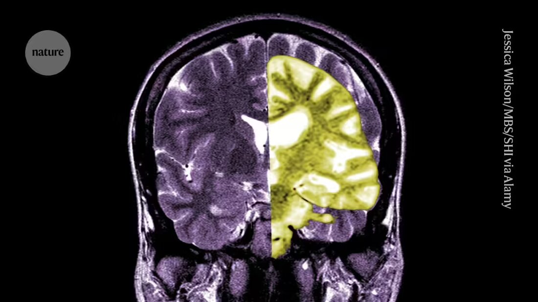 Die Debatte über das Alzheimer-Medikament Lecanemab, das eines der ersten Medikamente ist, das den kognitiven Verfall bei Menschen verlangsamen kann, intensiviert sich unter Forschern und Klinikern. Lesen Sie mehr über die Kontroverse und die Risiken und Vorteile der Behandlung.