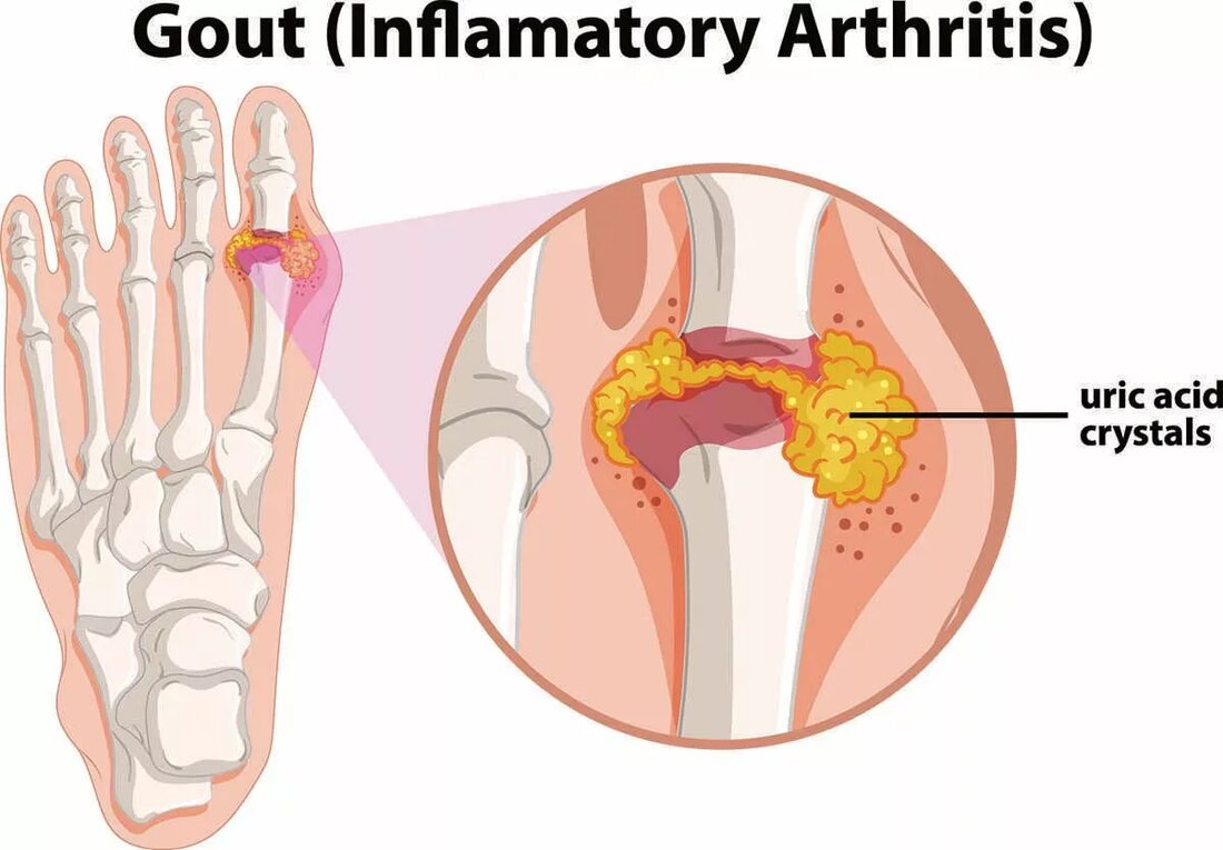Gelenkschmerzen betreffen Millionen von Menschen weltweit, wobei laut CDC allein in den Vereinigten Staaten über 54 Millionen Erwachsene an Arthritis leiden. Gicht, eine Art entzündlicher Arthritis, ist ebenfalls auf dem Vormarsch und betrifft 8,3 Millionen Amerikaner. Für diejenigen, die mit Gelenkschmerzen, Entzündungen oder Gicht zu kämpfen haben, ist es wichtig, Linderung zu finden, um die Lebensqualität zu erhalten. Glücklicherweise können bestimmte Lebensmittel, Kräuter und Gewürze helfen, diese Symptome zu lindern und gleichzeitig die Darmgesundheit zu verbessern. In diesem Artikel untersuchen wir 18 köstliche Lebensmittel, Kräuter und Gewürze, die durch wissenschaftliche Studien gestützt werden, wie Sie sie in Ihr tägliches Leben …