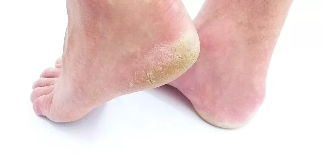 Fußpilz Hausmittel: Behandlung mit natürlichen Zutaten Der Fußpilz ist eine weit verbreitete Infektion, die durch den Pilz Tinea pedis verursacht wird. Dieser tritt oft zwischen den Zehen auf und führt zu Juckreiz, Brennen und Rötung der Haut. Fußpilz kann sehr unangenehm sein und die Lebensqualität beeinträchtigen. Glücklicherweise gibt es eine Vielzahl von Hausmitteln, die zur Behandlung dieser Infektion verwendet werden können. In diesem Artikel werden wir einige natürliche Zutaten und Methoden vorstellen, die bei der Bekämpfung von Fußpilz helfen können. Teebaumöl Teebaumöl ist bekannt für seine antibakteriellen und antimykotischen Eigenschaften. Es kann effektiv gegen Fußpilz eingesetzt werden. Um Teebaumöl zur …