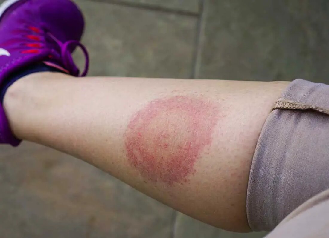 Lyme-Borreliose ist eine bakterielle Infektion, die durch das Bakterium Borrelia burgdorferi verursacht wird und durch den Stich infizierter schwarzbeiniger Zecken auf den Menschen übertragen wird. Es ist eine weit verbreitete Krankheit in den Vereinigten Staaten, mit Zehntausenden von gemeldeten Fällen jedes Jahr. Die Behandlung der Lyme-Borreliose kann schwierig sein, da sich die Bakterien in verschiedenen Formen verstecken und dem Immunsystem entgehen können. Übliche Behandlungen umfassen Antibiotika, aber ihre Erfolgsrate variiert, und bei einigen Patienten treten auch nach der Behandlung weiterhin Symptome auf, die als Post-Treatment-Lyme-Disease-Syndrom (PTLDS) oder chronische Lyme-Borreliose bekannt sind. Anzeichen und Symptome der Lyme-Borreliose sind: Bullaugenausschlag (Erythema migrans) …