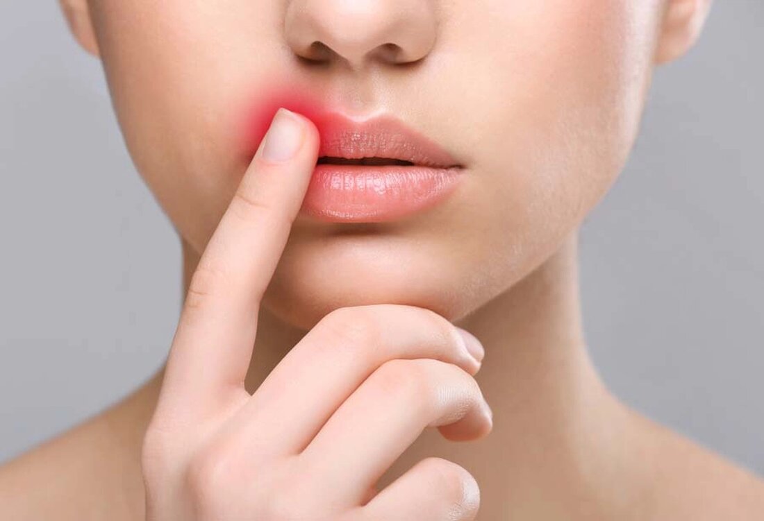 Hier finden Sie die gängigsten Hausmittel gegen Lippenherpes. Auch wenn es manchmal schwierig ist das richtige Hausmittel zu finden, so ist es doch manchmal gar nicht so weit entfernt. Die meisten Hausmittel haben Sie bereits in Ihrem Haushalt, wie der Name es schon vermuten lässt. Fieberbläschen sind irritierende rote Bläschen, die sich typischerweise im Gesicht, meist um den Mund herum, bilden. Sie können schmerzhaft sein und sind nicht gerade schön anzuschauen. . In den meisten Fällen ist das Herpes-simplex-Virus 1 (HSV-1) für Fieberbläschen verantwortlich. Wenn man einmal mit dem Herpes-simplex-Virus infiziert ist, hat man es ein Leben lang und eine …