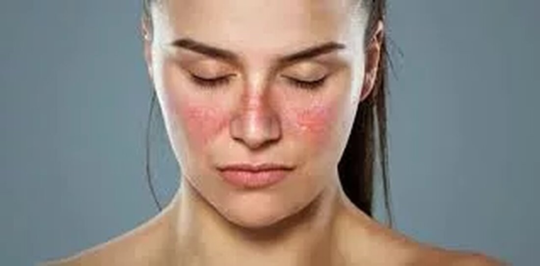 Die Symptome von Lupus kommen und gehen, das heißt, sie treten nicht ständig auf. Wenn die Symptome aufflackern, fühlen Sie sich krank. Manche Menschen greifen in solchen Situationen auf Hausmittel zurück, und Kokosnussöl ist eines der beliebtesten Mittel. Vorteile von Kokosnussöl für die Lupusbehandlung Wenn Sie unter Lupus-Symptomen leiden, sollten Sie Kokosnussöl ausprobieren, da es einige nachgewiesene Vorteile hat. Ein häufiges Symptom von Lupus ist extreme Müdigkeit. Sie können sich müde fühlen, auch wenn Sie genug Schlaf bekommen. Kokosnussöl ist reich an mittelkettigen Triglyceriden, die als schnelle Energiequelle dienen. Wenn Sie langkettige Triglyceride zu sich nehmen, gelangen die Moleküle über …