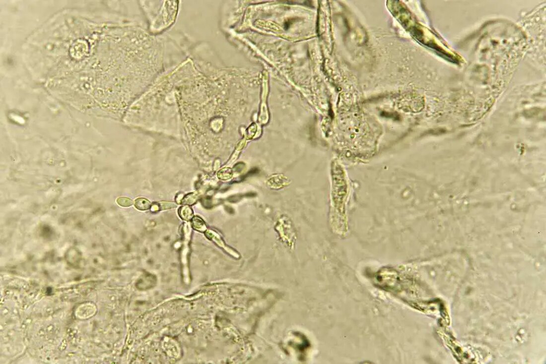Eine kürzlich durchgeführte Studie legt nahe, dass das Bakterium Escherichia coli (E. coli), das häufig in unzureichend gekochtem Fleisch vorkommt, möglicherweise für Hunderttausende von Harnwegsinfektionen (UTIs) in den Vereinigten Staaten verantwortlich ist, wobei Frauen überproportional betroffen sind. E. coli ist eine große und vielfältige Gruppe von Bakterien, die in der Umwelt, in der Nahrung und im Darm von Menschen und Tieren vorkommen. Während die meisten Stämme harmlos sind, können einige Krankheiten wie Harnwegsinfektionen, Lungenentzündung und andere verursachen. Forscher der George Washington University Milken Institute School of Public Health verwendeten einen neuartigen genomischen Ansatz, um die Ursprünge von E. coli-Infektionen in &hellip;