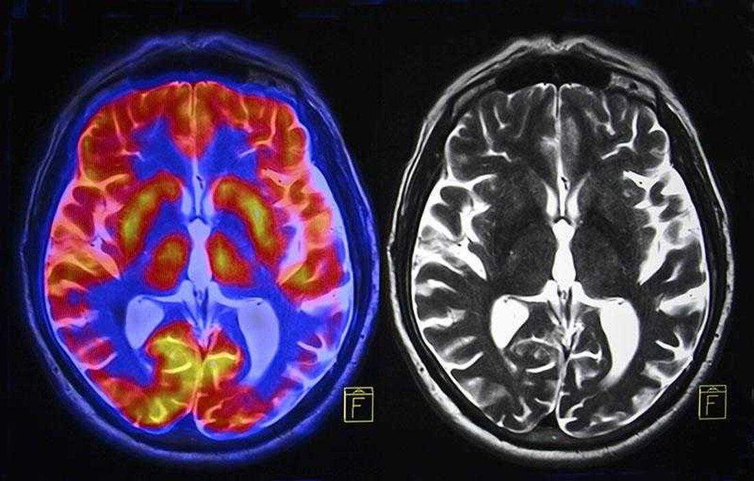 Traumatische Erfahrungen können tiefgreifende Auswirkungen auf unser Leben haben, sowohl geistig als auch körperlich. Wir wissen, dass ein Trauma lang anhaltende psychologische und emotionale Auswirkungen haben kann, aber neuere Forschungen haben gezeigt, dass es auch die physische Struktur und die Netzwerke des Gehirns verändern kann. Dies hat Auswirkungen auf unsere Lern- und Überlebensfähigkeiten, da die Art und Weise, wie wir Informationen verarbeiten und speichern, vollständig verändert werden kann. In diesem Artikel werden wir die Auswirkungen von Traumata auf unsere Gehirnnetzwerke untersuchen und wie sich dies auf unser Lernen und Überleben auswirken kann. Die Auswirkungen von Traumata auf unser Gehirn Die …