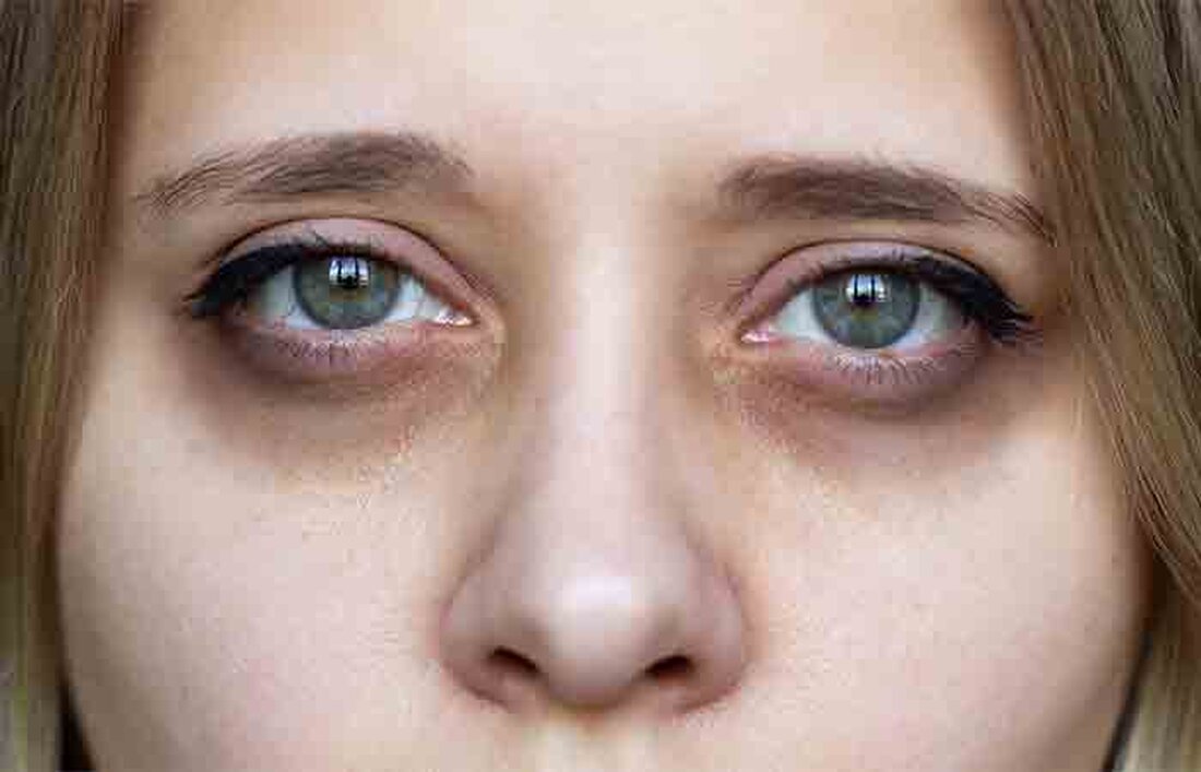 Hassen Sie es nicht auch, wenn alles an Ihrem Aussehen wunderbar passt und das einzige Problem, dunkle und hartnäckige Ringe unter Ihren Augen sind? Keine Sorge, den meisten von uns ist es irgendwann im Leben so gegangen. Wir verraten Ihnen ein Geheimnis: Selbst die schönsten Frauen müssen oft zu Concealern und Make-up greifen, um ihre Augenringe zu verbergen. Diese Augenringe lassen Sie nicht nur viel älter aussehen, als Sie tatsächlich sind, sondern sie lassen Sie auch krank / ungesund aussehen. Bevor wir uns auf diese natürliche Reise begeben, möchte ich Ihnen sagen, dass es Zeit braucht, um dunkle Augenringe zu …