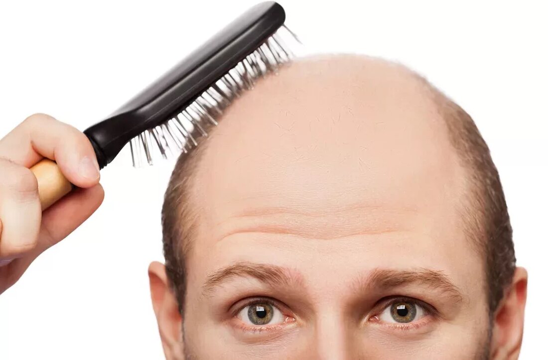 Haarausfall ist bei Asiaten im Vergleich zu Kaukasiern nicht sehr verbreitet. Es wird angenommen, dass dies auf die Ernährung zurückzuführen ist, obwohl auch der Haartyp und die Genetik der Grund sein könnten. Asiaten haben eine Ernährung, die viele verschiedene Gemüse- und Kräuterzutaten enthält. Dies soll ein Grund dafür sein, dass Haarausfall in der asiatischen Bevölkerung seltener vorkommt He Shou Wu Dies ist ein chinesisches Kraut, auch bekannt als Polygoni multiflori oder Fo Ti. Dieses Kraut ist dafür bekannt, das Haarwachstum zu stimulieren und Vellushaar, das sehr fein ist, in dickeres Haar zu verwandeln, das länger hält. He shou wu ist …