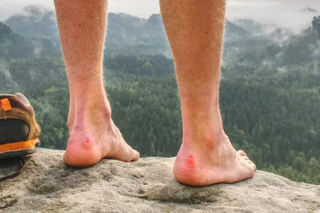 Blasen aufmachen… Ja oder Nein? Wir alle hatten schon mal Blasen an Händen oder Füßen. Vielleicht haben Sie Schuhe getragen, die ein wenig zu eng waren. Vielleicht war das Backblech doch noch zu heiß… Oder vielleicht haben Sie eine Krankheit oder eine Virusinfektion, die Blasen verursacht. Wir sprachen mit der Dermatologin Shilpi Khetarpal, MD, darüber, warum man die meisten Blasen nicht aufdrücken sollte und wie man stattdessen drei häufige Arten von Blasen behandelt. Soll man Blasen aufdrücken? Die kurze Antwort? In den meisten Fällen ein klares Nein. „Blasen sind die Art und Weise, wie Ihr Körper nach einer Verletzung einen …