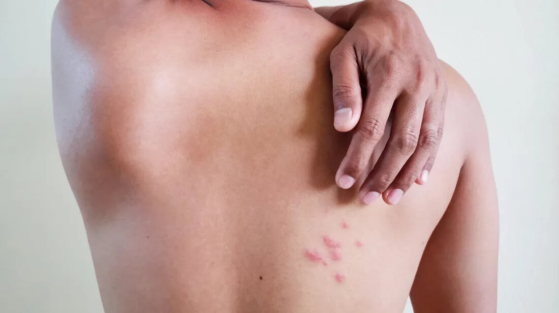 Gürtelrose (Herpes zoster) ist eine Virusinfektion, die einen schmerzhaften Hautausschlag verursacht. Das Varizella-Zoster-Virus (VZV) verursacht diese Virusinfektion. Es ist das gleiche Virus, das Windpocken verursacht . Wenn Sie als Kind Windpocken hatten, schlummert das Gürtelrosevirus in Ihrem Körper. Das Virus kann sich später im Leben reaktivieren und einen Gürtelrose-Ausschlag verursachen. Der Ausschlag kann an jedem Teil Ihres Körpers auftreten, betrifft aber typischerweise nur kleine Bereiche. Schmerzen sind in der Regel das erste Symptom einer Gürtelrose. Der Ausschlag und die mit Flüssigkeit gefüllten Blasen bilden sich innerhalb weniger Tage nach Beginn der Schmerzen. Manche Menschen mit Gürtelrose haben auch Fieber , …