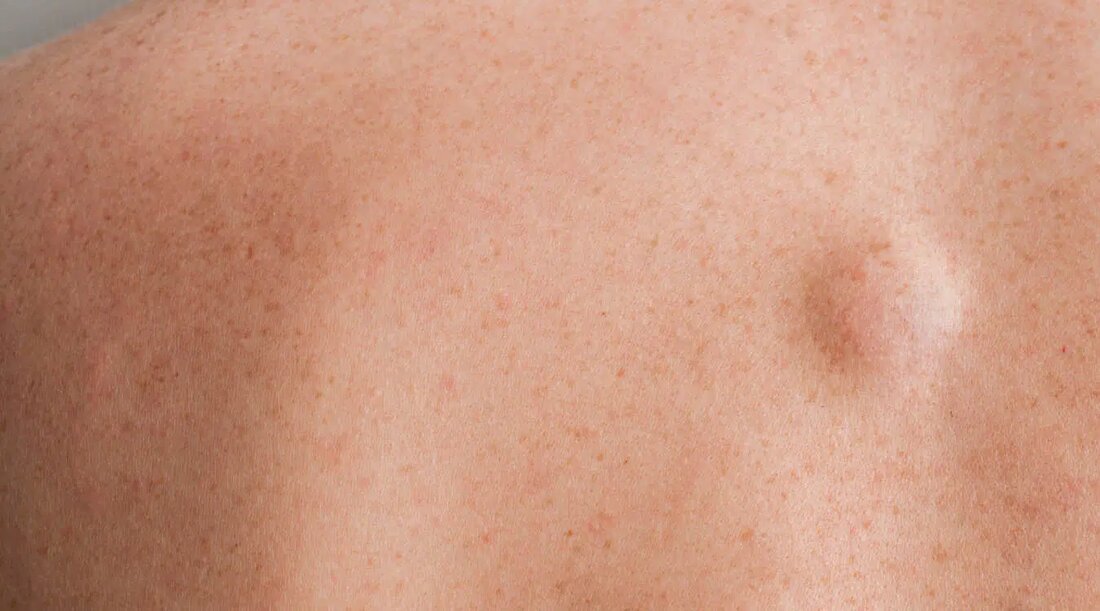 Was sind Lipome? Lipome sind schmerzlose, weiche, runde oder ovale Fettklumpen, die unter Ihrer Haut wachsen. Lipome fühlen sich „teigig“ an und bewegen sich bei Berührung. Sie können überall am Körper entstehen, sind aber vor allem an Rücken, Schultern und Nacken zu finden. Sie können in allen Altersgruppen vorkommen, treten aber hauptsächlich im mittleren Alter auf. Lipom treten bei Männern und Frauen gleich häufig auf. Multiple Lipome treten häufiger bei Männern auf. Sie sind nicht krebsartig und müssen nicht entfernt werden, es sei denn, sie verursachen Symptome. Ihr Vorhandensein an sichtbaren Stellen des Körpers kann jedoch unangenehm und peinlich sein. …