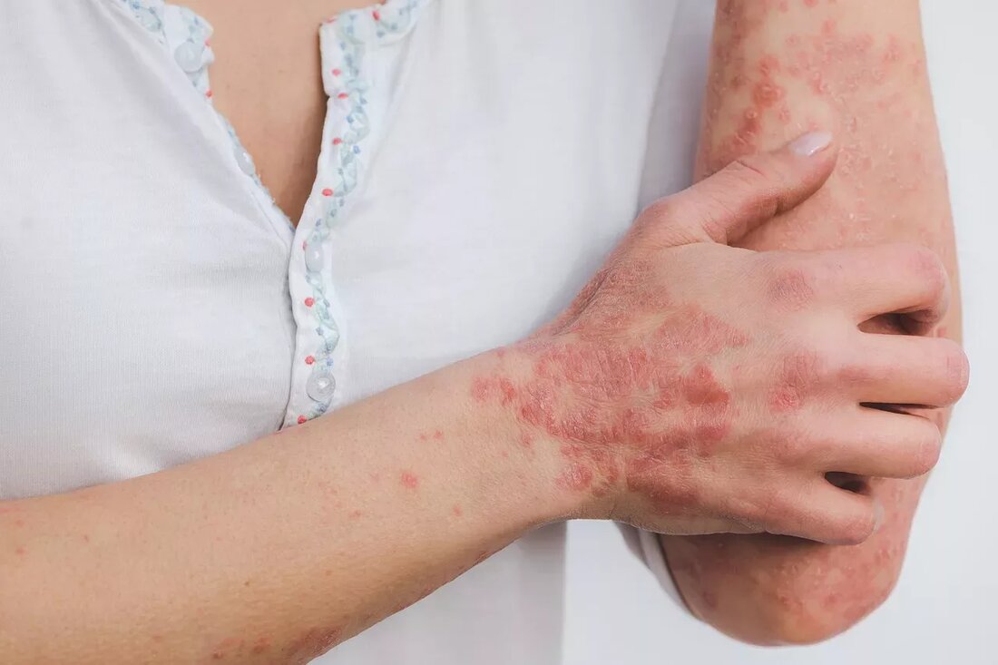 Schuppenflechte (Psoriasis) kann für Betroffene eine Reihe von Beschwerden mit sich bringen. Vom Juckreiz der trockenen, rissigen und schuppigen Hautstellen bis hin zu gelegentlichen Schmerzen können Menschen mit Psoriasis immer etwas Linderung gebrauchen. Unabhängig davon, ob Sie häufig oder nur gelegentlich unter Psoriasis leiden, ist es immer gut zu wissen, wie Sie die Symptome am besten lindern können. Umso besser, wenn Sie dies tun können, ohne einen Arzttermin vereinbaren zu müssen. Um die besten Hausmittel gegen Schuppenflechte in den Griff zu bekommen, haben wir mit dem Dermatologen Sean McGregor, DO, gesprochen. Was ist Schuppenflechte? Laut Dr. McGregor ist Psoriasis eine …