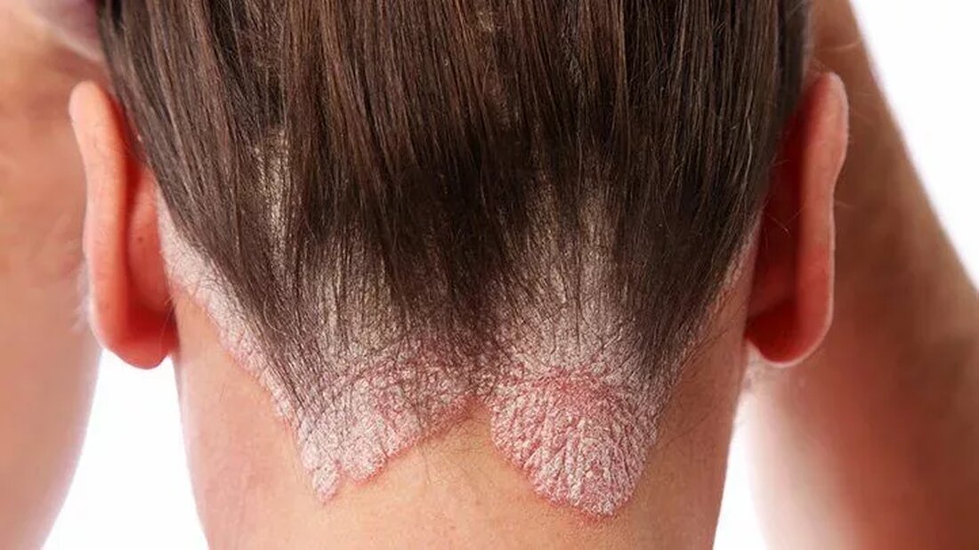 Psoriasis ist eine häufige Hauterkrankung, bei der sich schnell Hautzellen auf der Hautoberfläche ansammeln. Bei helleren Hauttönen kann sie rosa oder rot mit einer silbrig-weißen Schuppung erscheinen. Bei mittleren Hauttönen kann sie lachsfarben mit einer silbrig-weißen Schuppung erscheinen. Bei dunkleren Hauttönen kann die Psoriasis violett mit grauen Schuppen erscheinen. Sie kann auch dunkelbraun und schwer zu erkennen sein. Kopfhautpsoriasis ist eine chronische Erkrankung, das heißt, sie mit der Zeit kommt und geht. Oft wird sie durch bestimmte Faktoren ausgelöst oder verschlimmert Faktoren wie z.B.: Stress Alkoholkonsum Rauchen Es ist wichtig, die Kopfhautpsoriasis zu behandeln und die Symptome für andere Erkrankungen. …