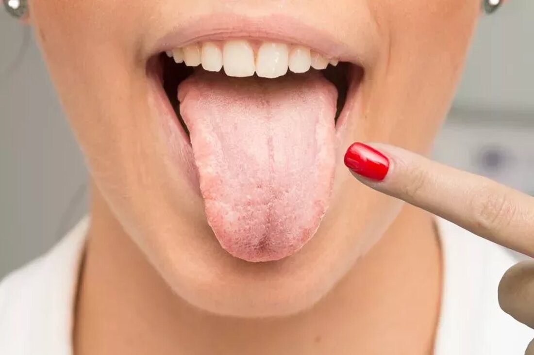 Was ist das weiße Zeug auf meiner Zunge? Und warum fühlt sich Ihr Mund „komisch“ an – vielleicht ein bisschen wie Sandpapier? Möglicherweise ist es ein Anzeichen auf Soor. Soor kann jeden treffen, aber manche Menschen sind sehr viel anfälliger. „Soor tritt in der Regel bei Kindern auf, deren Immunsystem sich noch in der Entwicklung befindet, oder bei älteren Erwachsenen, deren Immunsystem allmählich abbautt“, sagt der HNO-Arzt Tony Reisman, MD. „Menschen, die an Krankheiten leiden, die das Immunsystem beeinträchtigen, sind ebenfalls anfälliger. Auch wenn Soor in der Regel von selbst wieder verschwindet, gibt es Hausmittel, die die Heilung beschleunigen und …