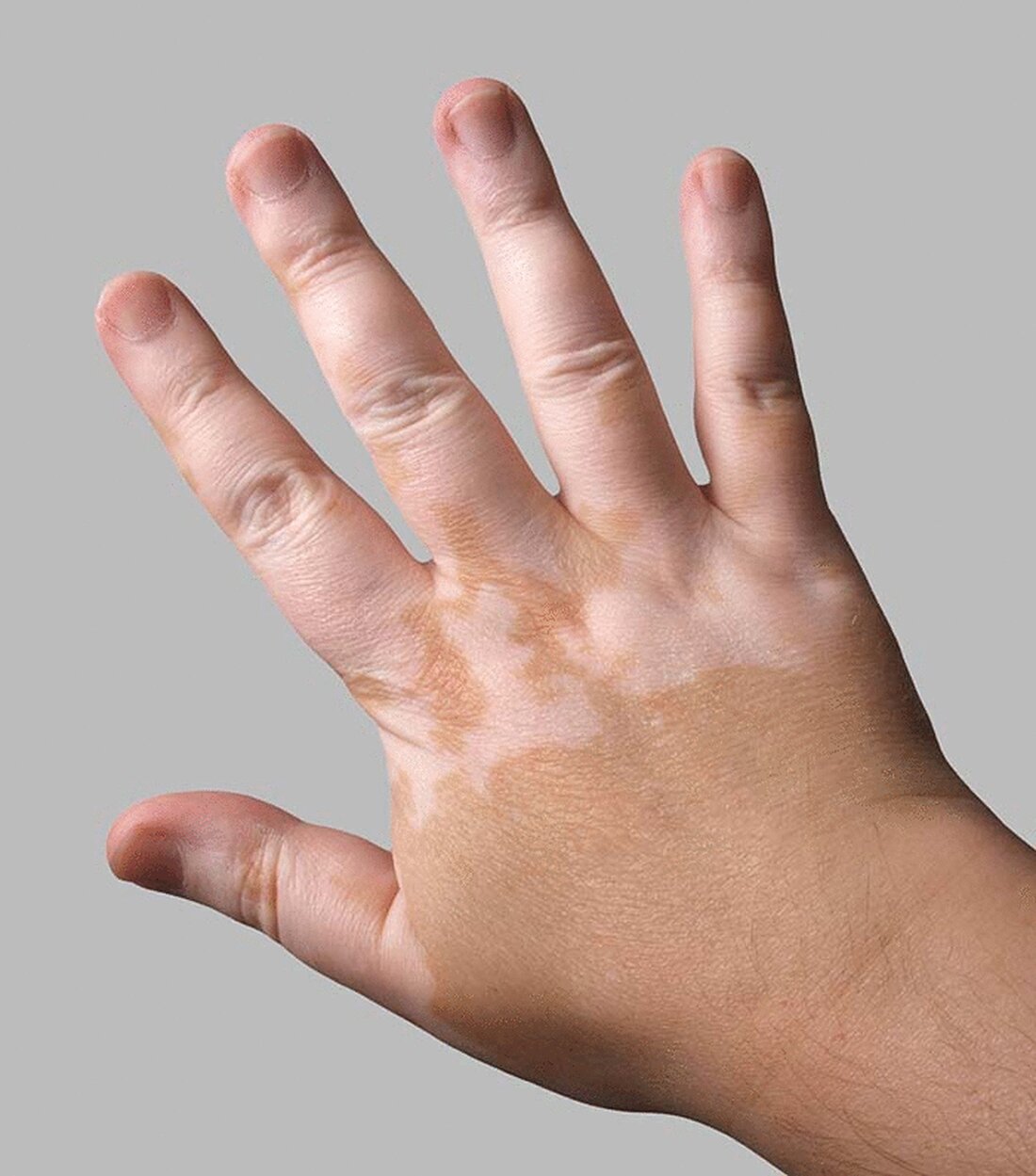 Hier finden Sie die gängigsten Hausmittel gegen Vitiligo. Auch wenn es manchmal schwierig ist das richtige Hausmittel zu finden, so ist es doch manchmal gar nicht so weit entfernt. Die meisten Hausmittel haben Sie bereits in Ihrem Haushalt, wie der Name es schon vermuten lässt. Der Welt-Vitiligo-Tag wird am 25. Juni gefeiert. Dieser Tag wird gefeiert, um die Welt auf die Symptome, Ursachen und Behandlung der Krankheit aufmerksam zu machen. Vitiligo zerstört die Melanin-Pigmentzellen. Das Melanin ist dafür verantwortlich, der Haut ihre Farbe zu verleihen. Aufgrund des Fehlens von Melanin an bestimmten Stellen entwickelt die Haut weiße Flecken. Die Flecken sind bei Menschen mit dunkler …