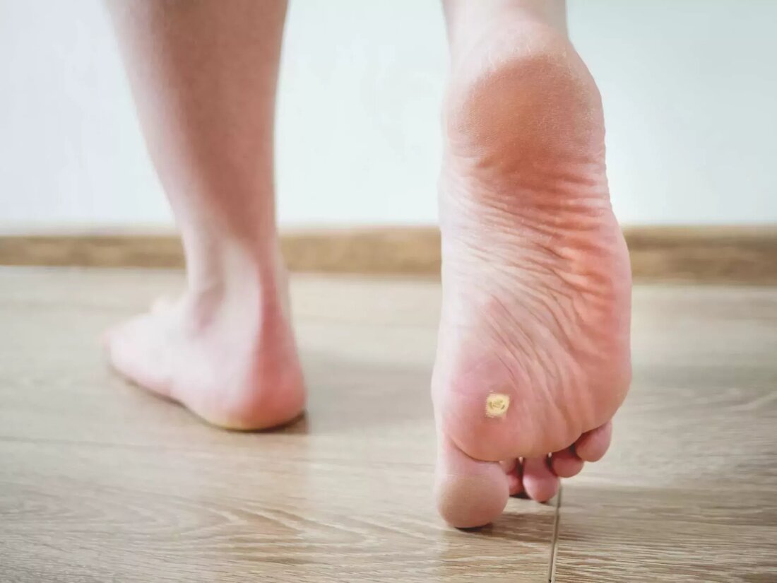 Es gibt verschiedene Arten von Warzen, da verschiedene Stämme des HPV-Virus unterschiedlich reagieren. Warzen treten erst Monate nach dem Befall auf. Daher ist die erste Verteidigungslinie gegen Warzen eine umsichtige Vorbeugung. Die meisten Menschen haben irgendwann in ihrem Leben Warzen, und Kinder sind häufiger betroffen als Erwachsene. Frisches Gemüse, Vollkornprodukte und Obst helfen, den Körper auf natürliche Weise zu stärken. Achten Sie außerdem auf eine Ernährung, die reich an Vitamin A ist und Lebensmittel wie Kürbis, Karotten, Papaya, Mangos, Aprikosen und Mandeln enthält. Hausmittel gegen Warzen Klebeband Die Methode ist einfach und wird seit langem angewendet. Kleben Sie ein kleines …