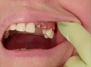 1658947578_Hausmittel-zur-Reparatur-eines-gebrochenen-oder-rissigen-Zahns