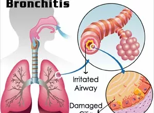 1658969243_Hausmittel-gegen-Bronchitis