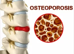 1660399156_Hausmittel-gegen-Osteoporose