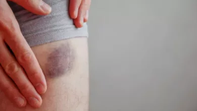 bruises