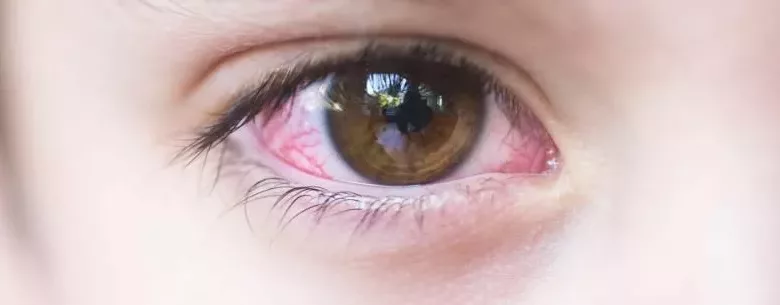 Pink-Eye-Closeup