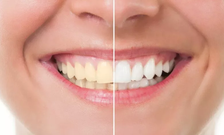 whiten-teeth