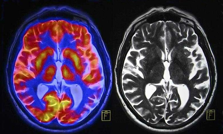 Trauma-Exposition-kann-Gehirnnetzwerke-veraendern-die-mit-Lernen-und-Ueberleben-verbunden