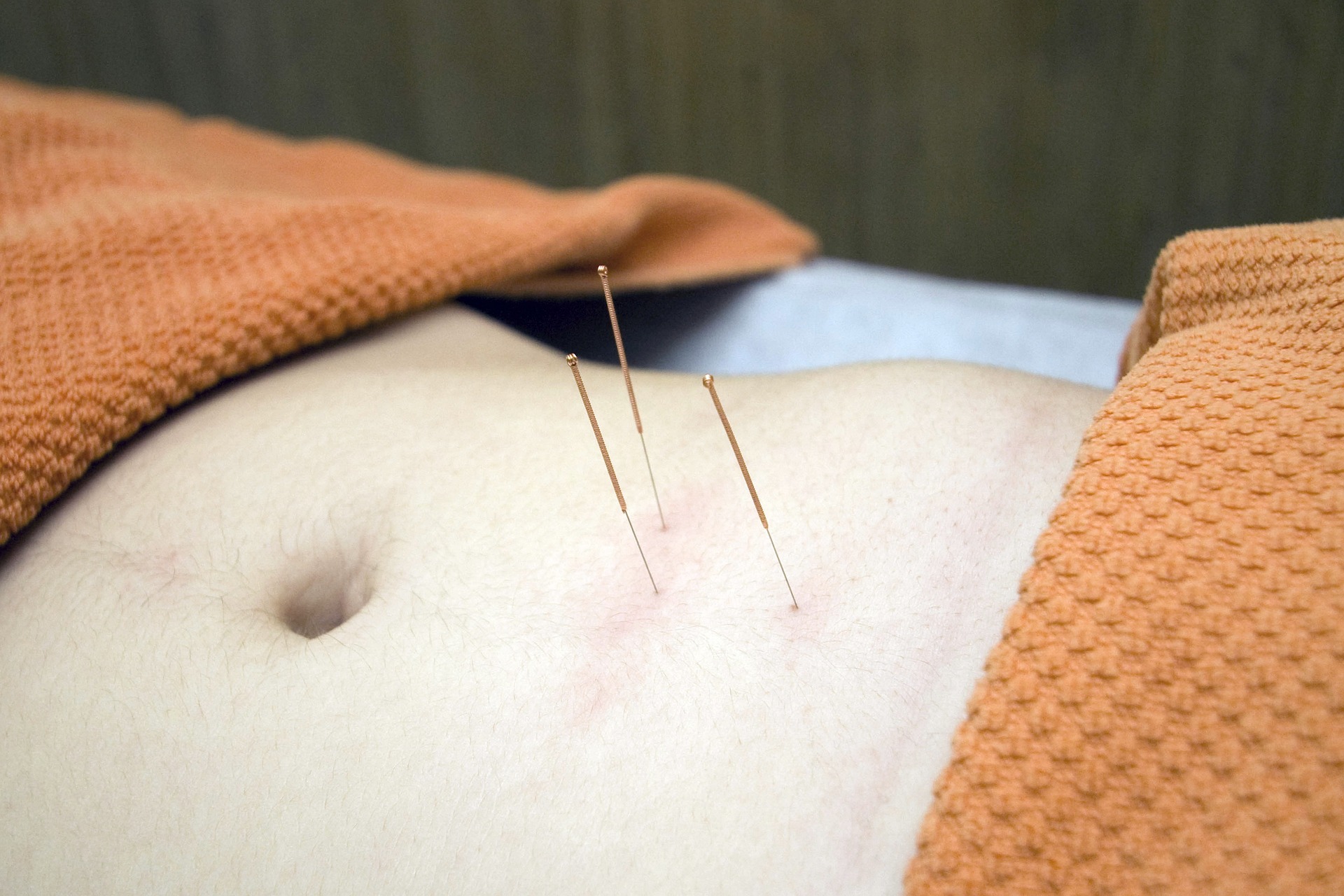 Traditionelle Körperakupunktur